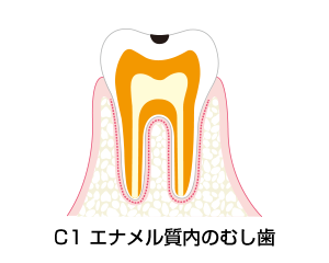 C1－エナメル質内のむし歯