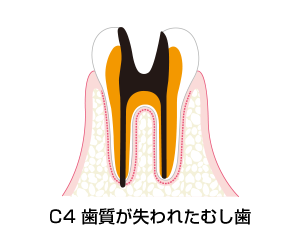 C4－歯質が失われたむし歯